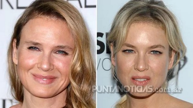Las consecuencias de las cirugías en el rostro de Renée Zellweger